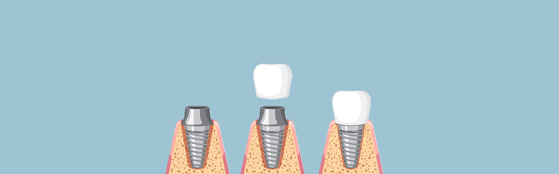 Key Steps in the Dental Implant Treatment Process