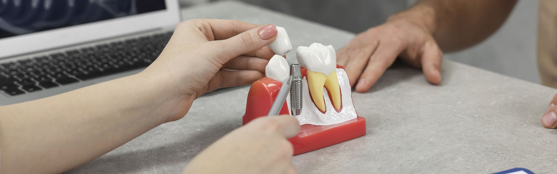 What to Expect Before, During, and After a Dental Implant Procedure