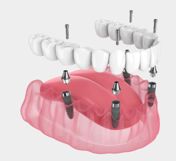 Who’s a Candidate for All-on-4 Dental Implants?