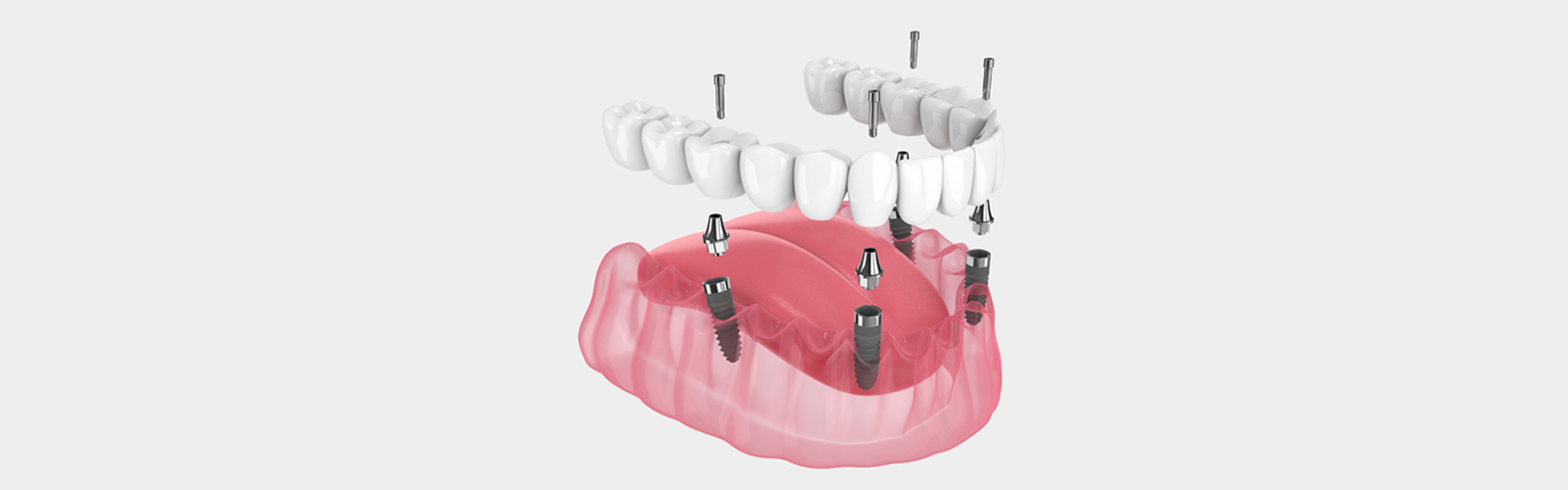 Who’s a Candidate for All-on-4 Dental Implants?