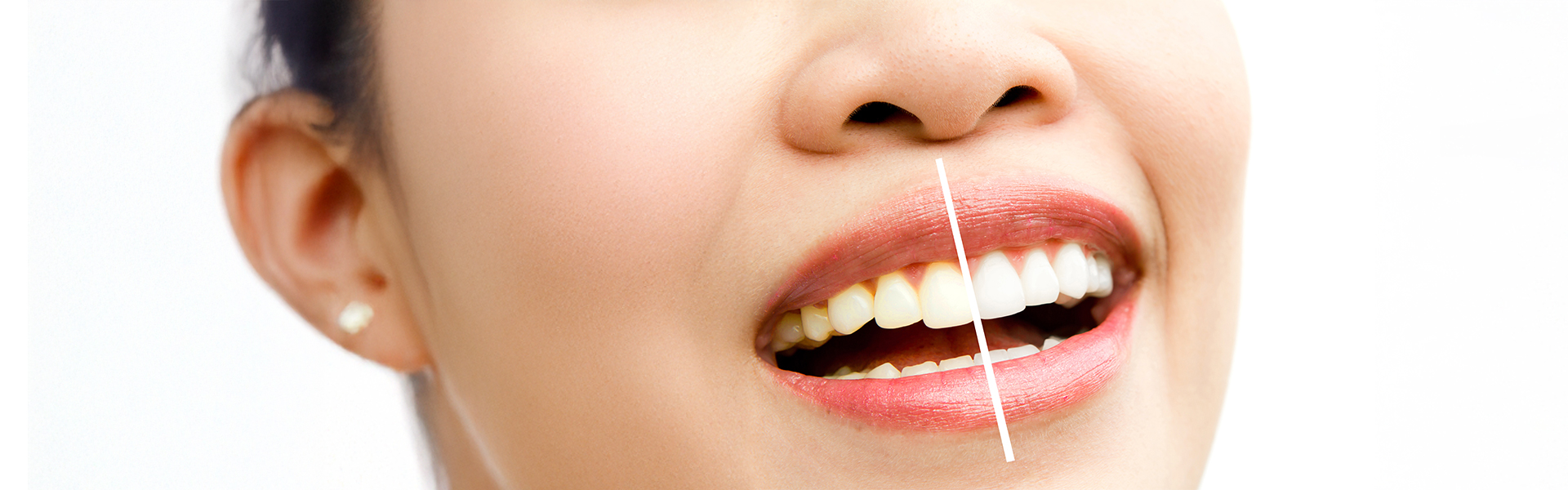 Foods to Avoid After Whitening Your Teeth